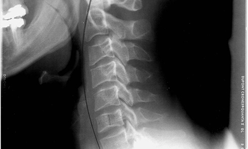 subluxation-vertebrale-chiropratique-hull